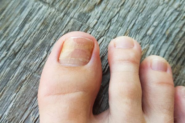 Tirnak-Mantari-Tedavisi-3