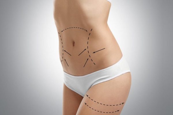 ameliyatsiz-karin-germe