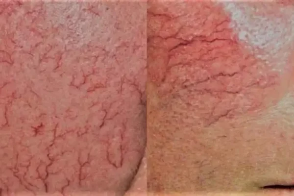 kilcal-damar-tedavisi