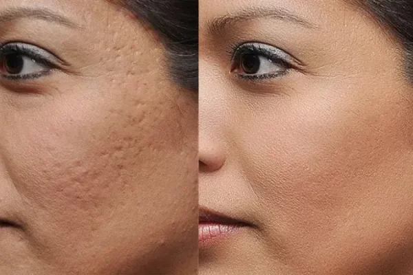 skar-yara-izi-nasil-gecer-skar-ve-yara-izi-tedavisi-nasil-olur-ciltteki-cesitli-izler-lekeler-neden-olur-nasil-duzelir-v4zt