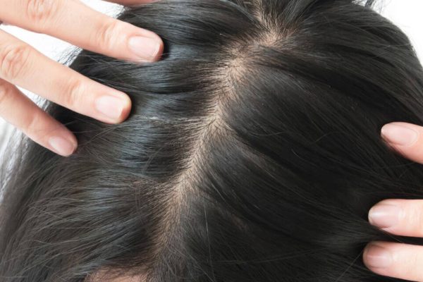 kadinlarda-sac-dokulmesi