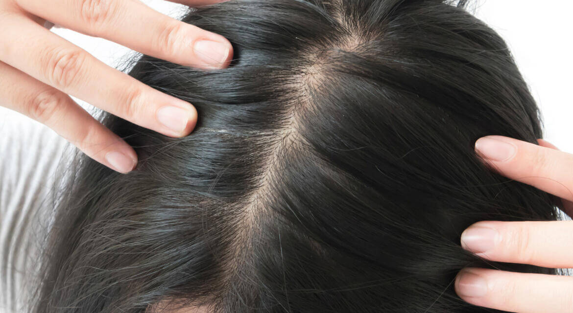 kadinlarda-sac-dokulmesi