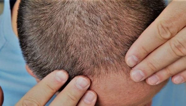 lazerle-sac-tedavisi