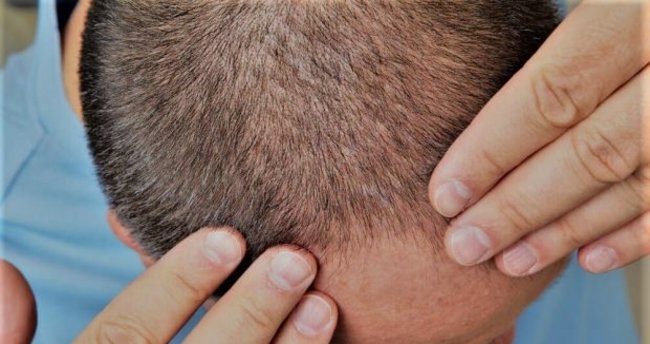 lazerle-sac-tedavisi