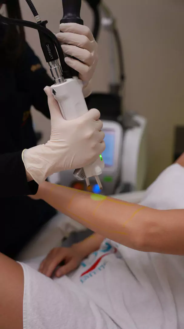 sarı tüylere lazer epilasyon