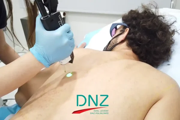 lazer-epilasyon-fiyatlari