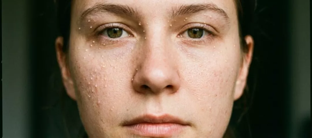 yag-bezesi-nasil-gecer