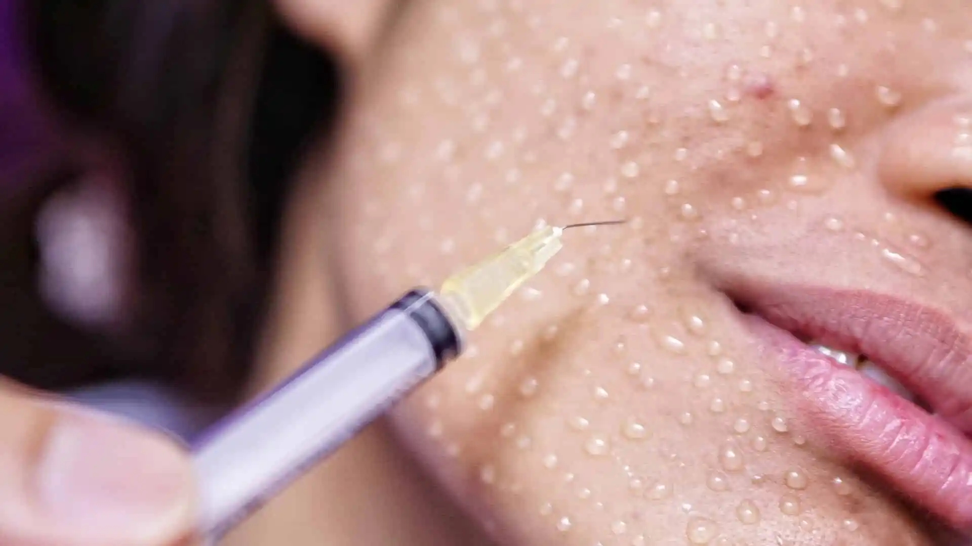 Yüz Mezoterapi Yaptıranlar Yorumlar